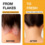 Load image into Gallery viewer, Psoriasis Shampoo for Dry Itchy Scalp Psoriasis Scalp Treatment for Eczema Relief Seborrheic Dermatitis Ringworm & Folliculitis Itchy Scalp Shampoo for Flakes Acne with Manuka Honey