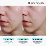 Load image into Gallery viewer, Anti Acne Supplements Cystic Acne Treatment for Teens Breakout Control 60 Caps