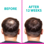 Load image into Gallery viewer, T2 Hair Loss Leave In Vials for Weak and Fine Hair (12 vials x 0.27 fl oz)   Natural Hair Growth Oil Scalp Treatment for Women and Men   Intensive Root Strengthening Treatment with Peppermint Rosemary and Castor Oil by